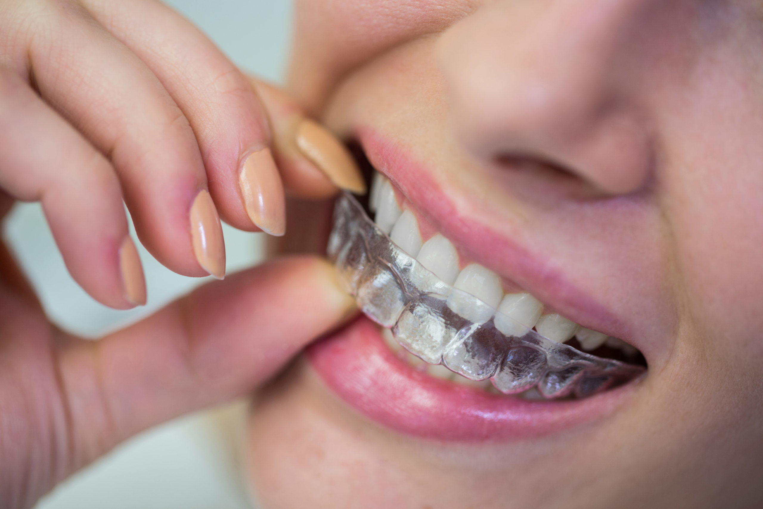 Ortodoncia Invisible en Valencia 2026 Invisalign
